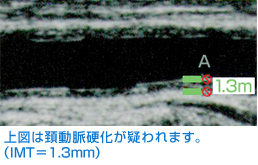 上図は頚動脈硬化が疑われます。(IMT=1.3mm)
